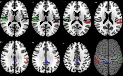 Circadian Variation of Migraine Attack Onset Affects fMRI Brain Response to Fearful Faces